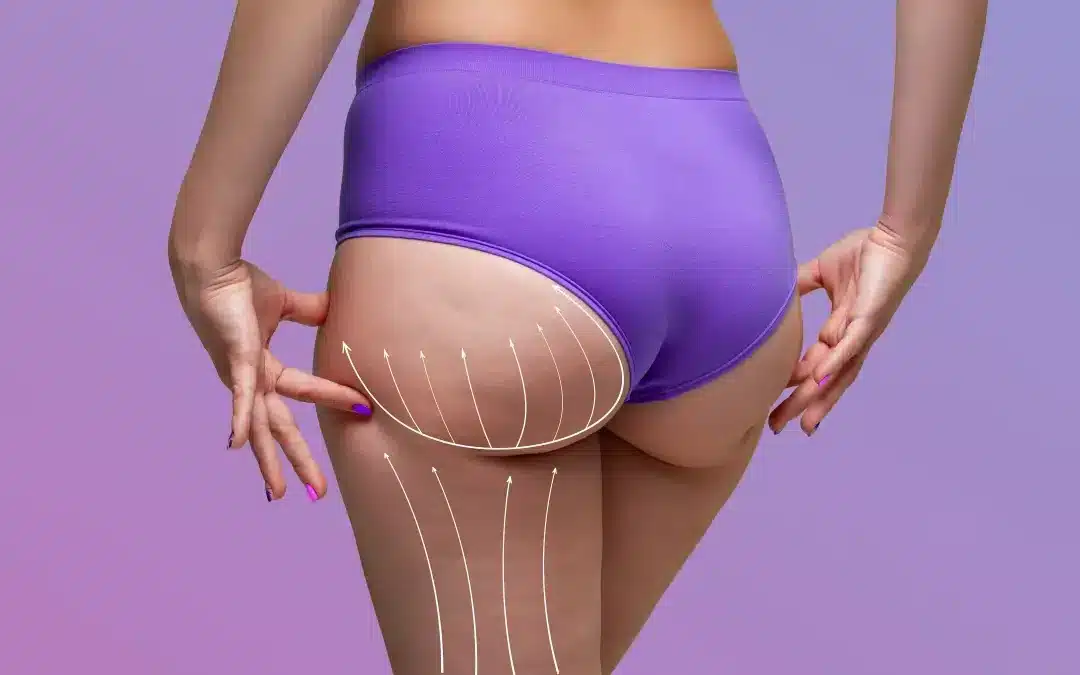 Endo-One Diode Laser for Body Contouring & Skin Tightening in Miami, FL